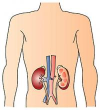 慢性腎臓病(CKD)